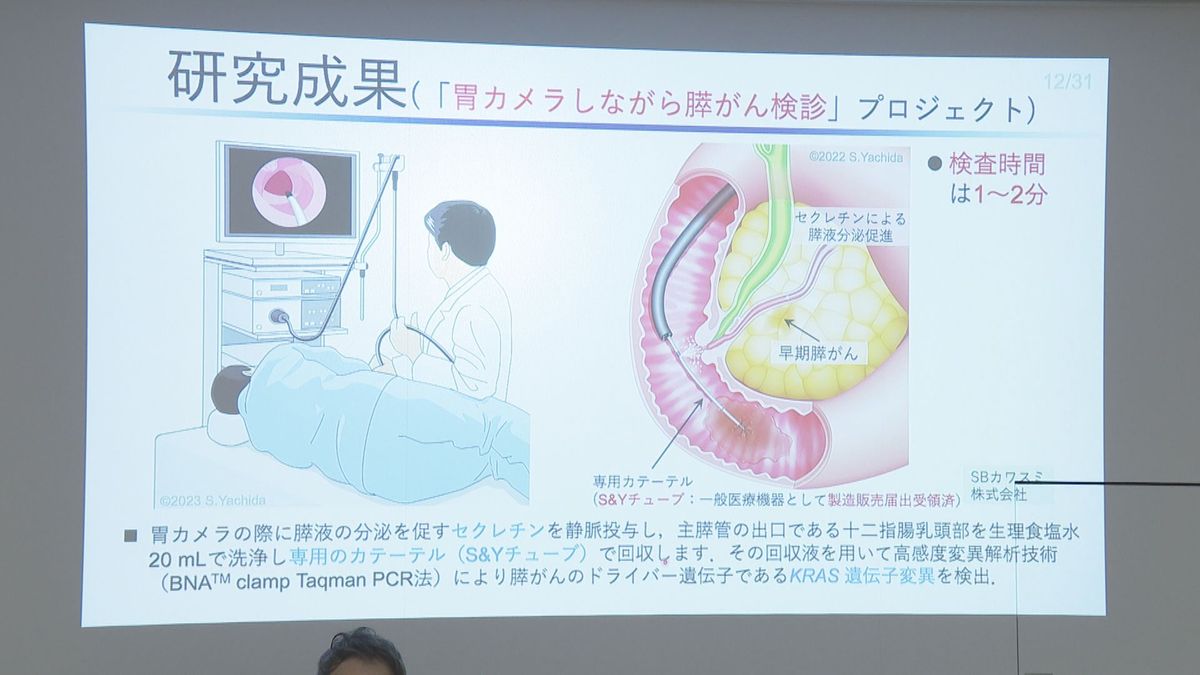 胃カメラで「膵がん」早期発見へ　がん細胞由来の遺伝子の変異を検出　大阪大学など研究グループが開発