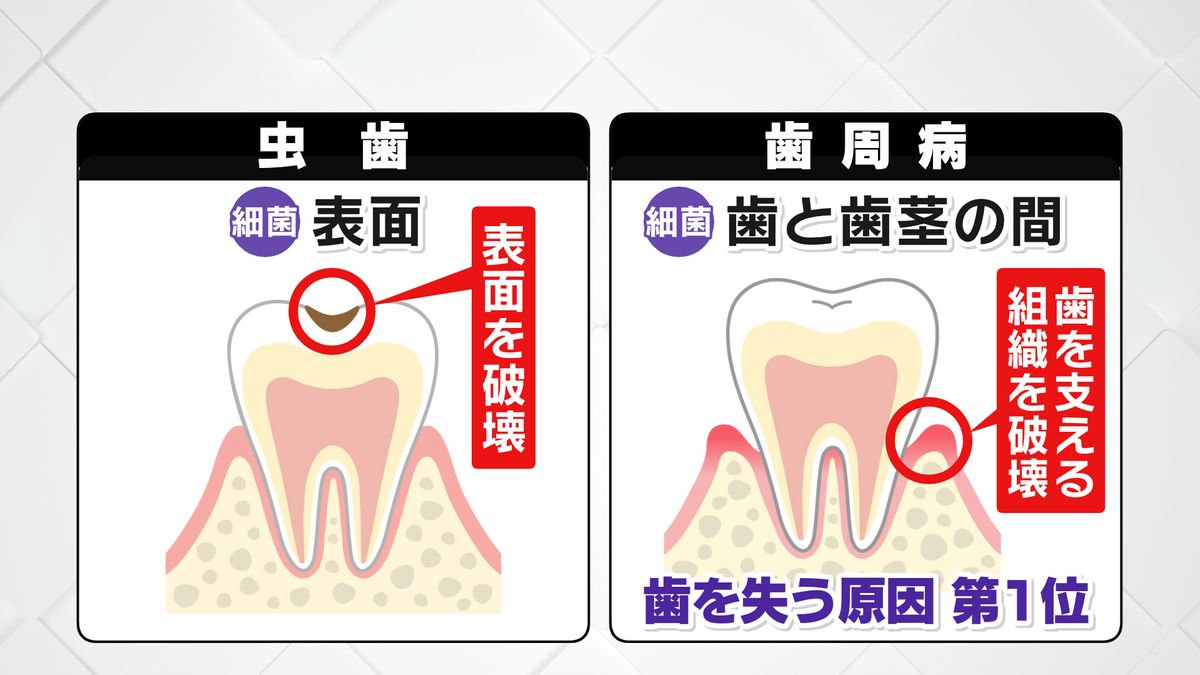 虫歯と歯周病の違い