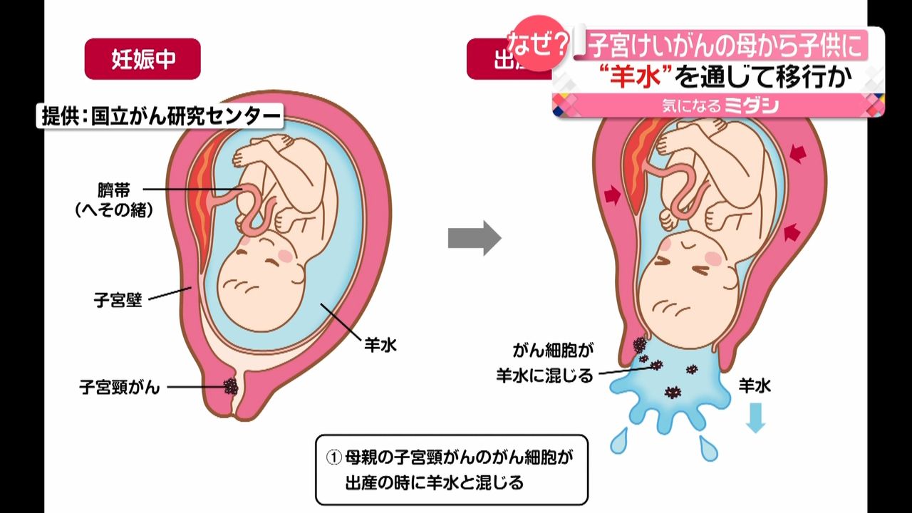 母親のがんが赤ちゃんに…羊水が原因か？｜日テレNEWS NNN