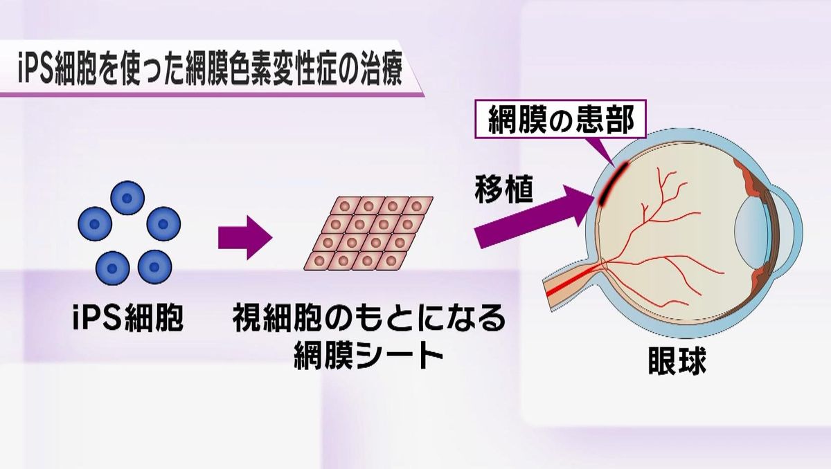 世界初　ｉＰＳ細胞「網膜シート」移植手術