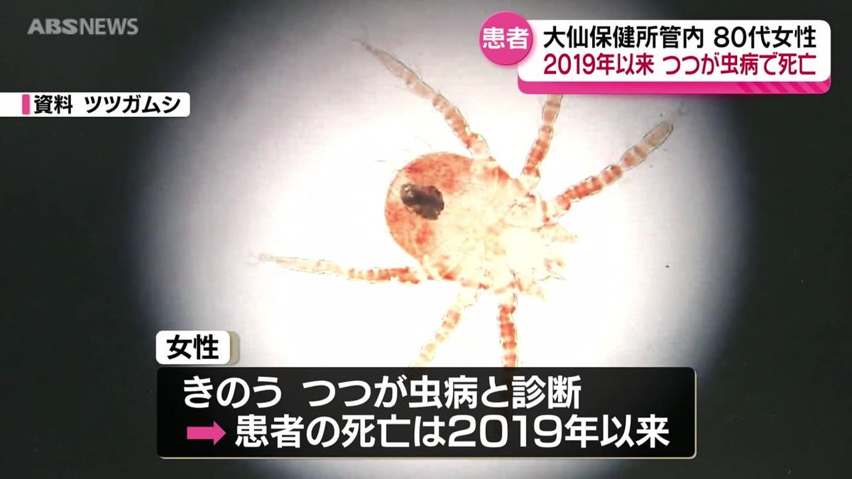 つつが虫病の80代女性が死亡　県内では2019年以来　大仙保健所