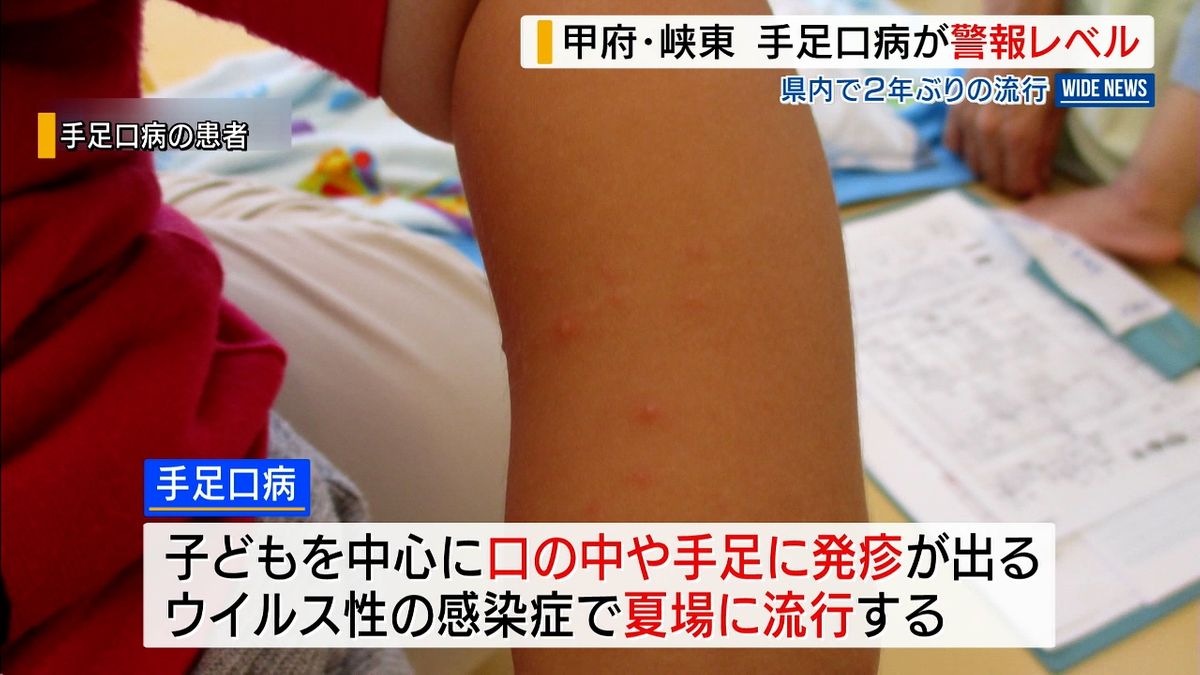 「手足口病」警報レベルに 甲府と峡東 県内では2年ぶり 手洗いなど呼びかけ 山梨県