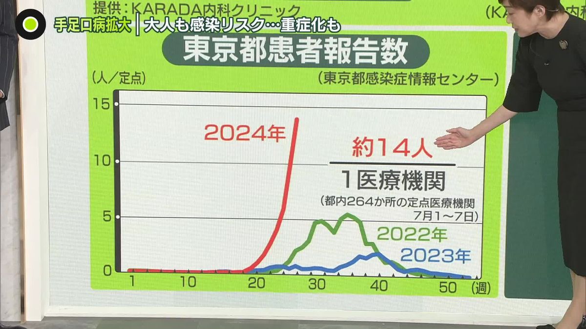 “手足口病拡大”患者数「警報」レベルの約3倍　大人も感染リスク…重症化も　対策は？