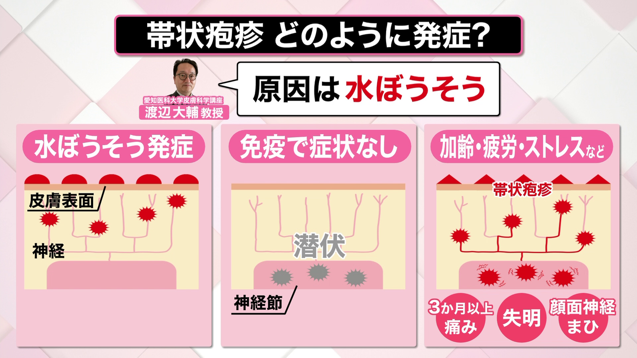 解説】この時期に気をつけたい「帯状疱疹」 “失明”合併症の可能性も 若い世代でなぜ増えた？｜日テレNEWS NNN