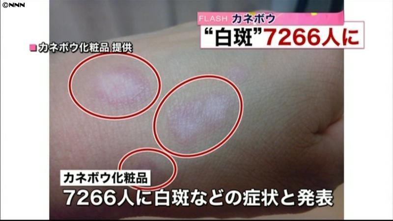 販売済み 美白化粧品 白斑被害 洗顔料