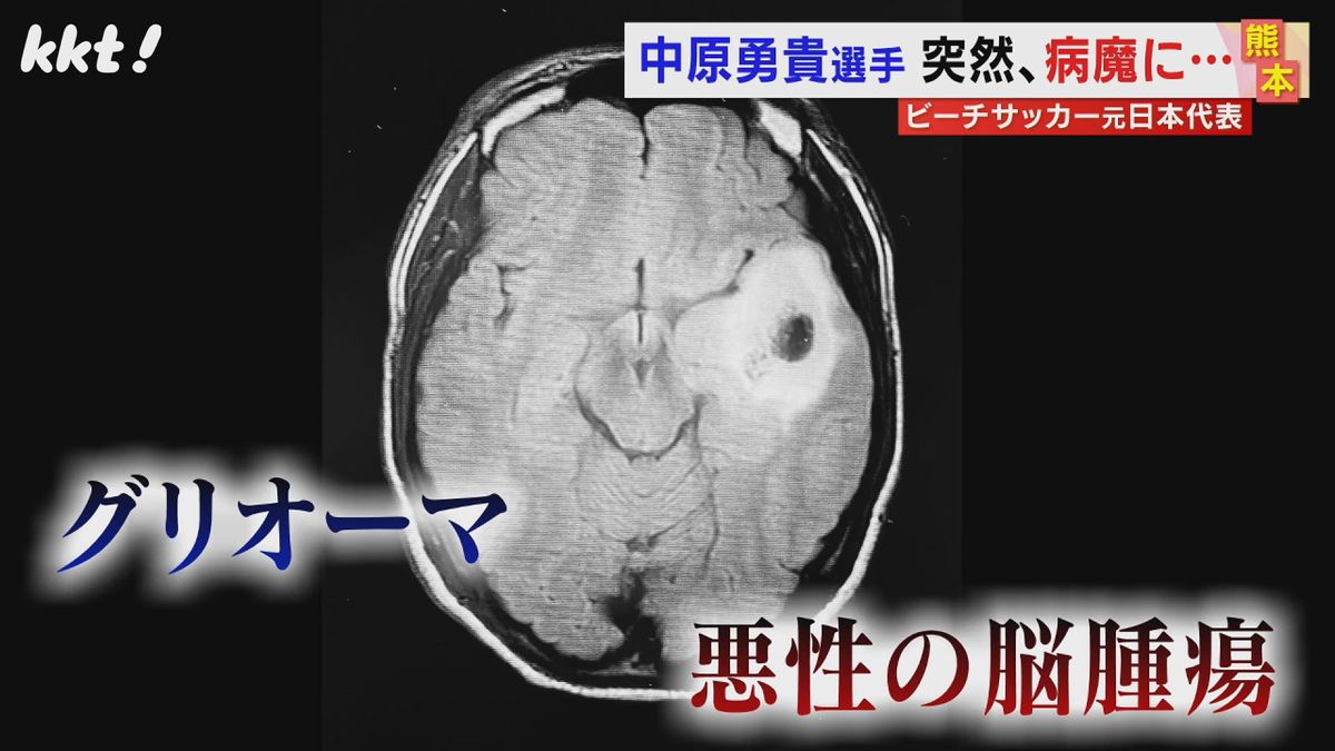 悪性の脳腫瘍｢グリオーマ｣と診断