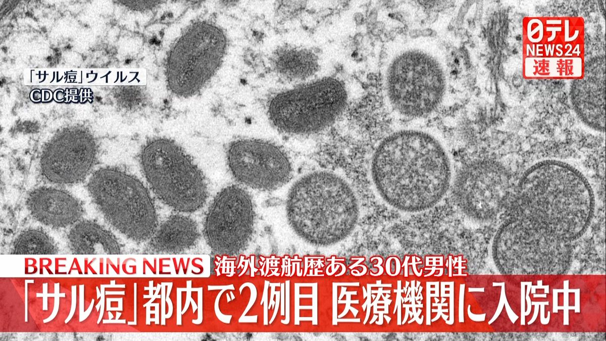 国内2例目「サル痘」感染者を確認　海外渡航歴のある都内男性　東京都