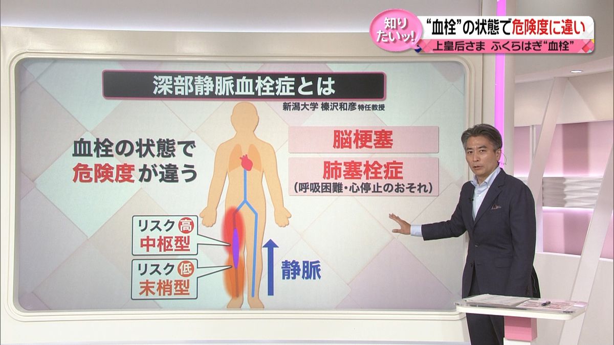 【解説】上皇后さま“血栓症”と診断　無症状「8割」同じ姿勢で長時間過ごしがちな今…予防法は？