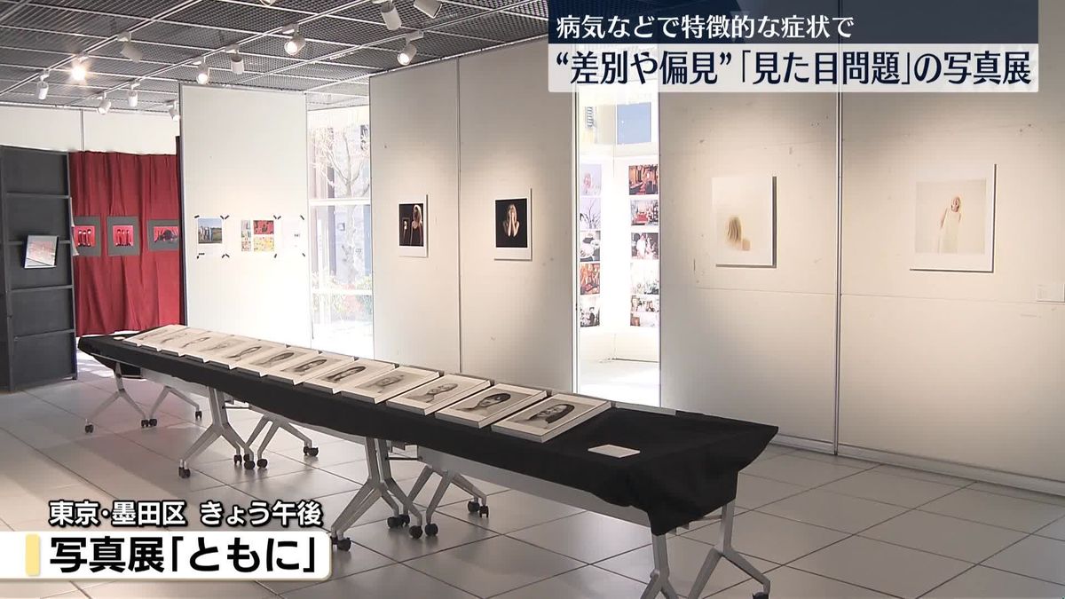 “差別や偏見”「見た目問題」の写真展　病気などで特徴的な症状で