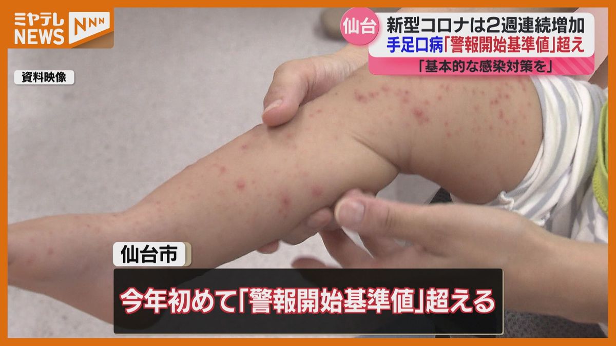 【手足口病】仙台市で今年初めて＜警報開始基準値＞上回る　1医療機関あたりの患者数