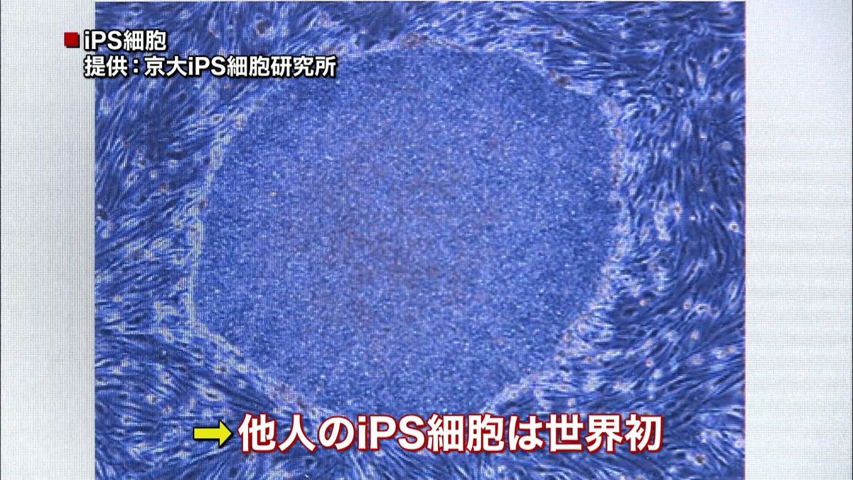 世界初、他人のｉＰＳ移植　厚労省が了承