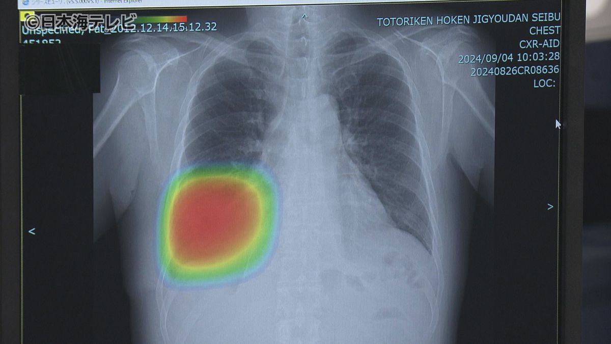 中四国の健診センターで“初”　レントゲン検診にAIシステムを導入　医師の負担軽減や診断の効率化へ　鳥取県