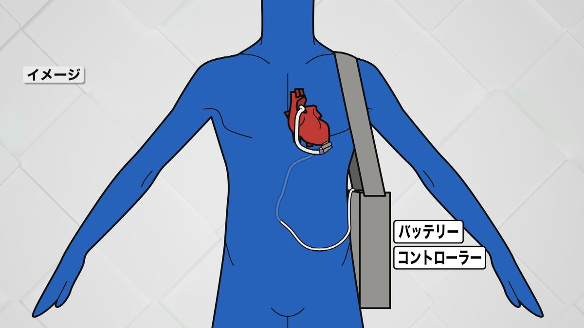 植込型補助人工心臓のイメージ