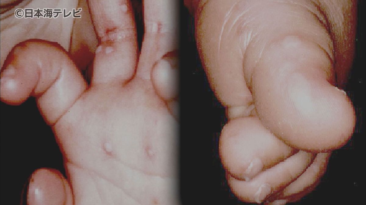 全国的に急増「手足口病」なぜ増加？　乳幼児だけでなく大人もかかる感染症　その対策は？　