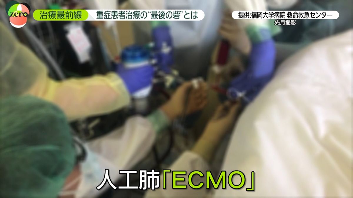 コロナ重症最後の砦　ＥＣＭＯ治療の最前線